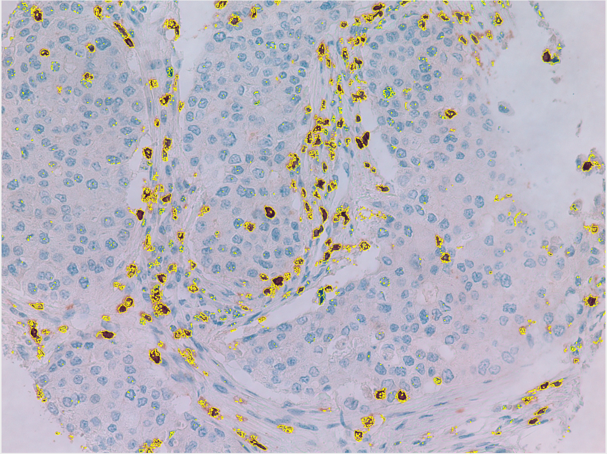 Stained immune cells IHC Slide